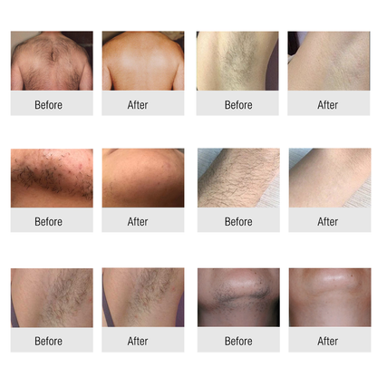 Winkonlaser Non-Crystal 808Nm Diode Laser Hair Removal Machine